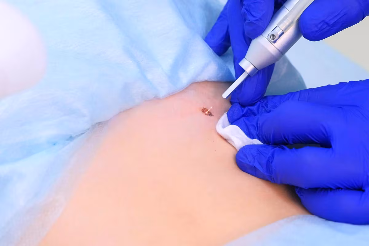Asportazione Papillomi e Fibromi con Laser