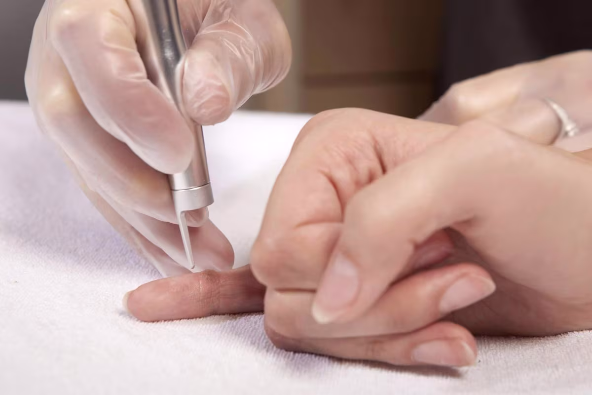 Asportazione Verruche con Laser